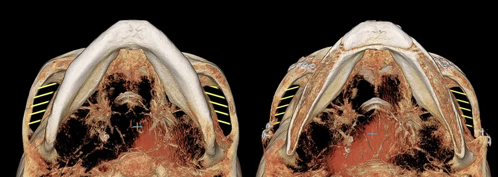 Facial contouring CT before and after 4