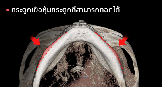 การตัดเปลือกกระดูกชั้นนอกของขากรรไกรล่างออก