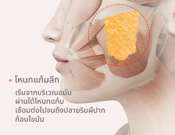 ไขมันส่วนเกินในกระพุ้งแก้มมจะถูกนำออกเพื่อทรงหน้าที่เรียวขึ้น