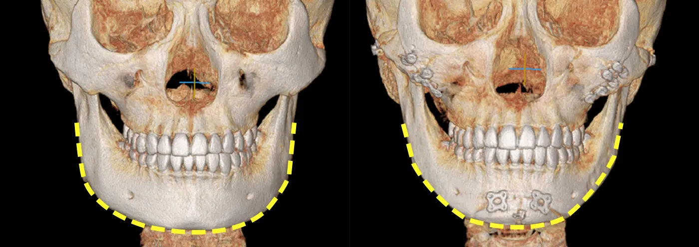 맥미걸 악플콜렉터 수술 전후 ct 사진