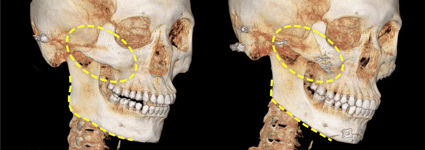 맥미걸 악플콜렉터 수술 전후 ct 사진