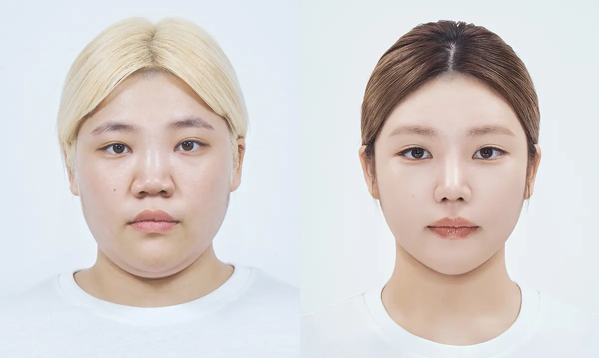 맥미걸 악플콜렉터 수술 전후 의학 사진