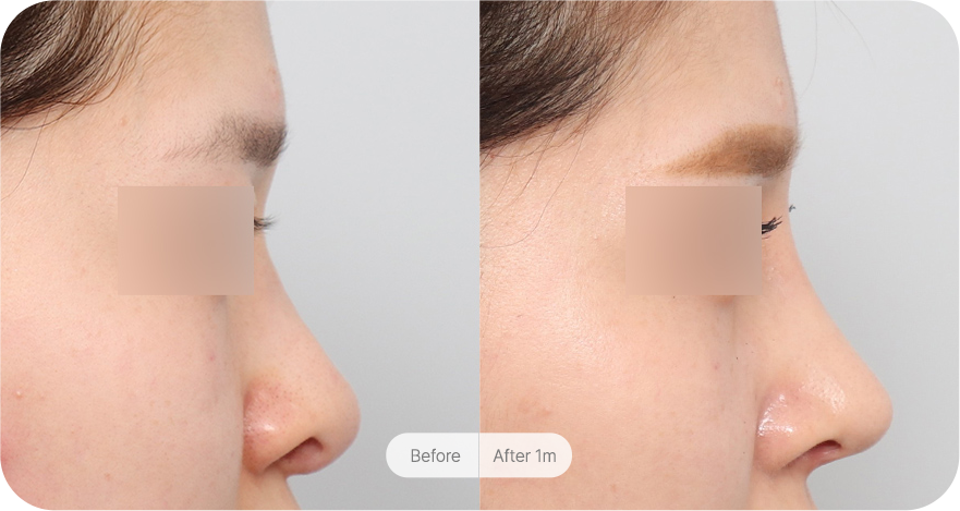 revision-rhinoplasty