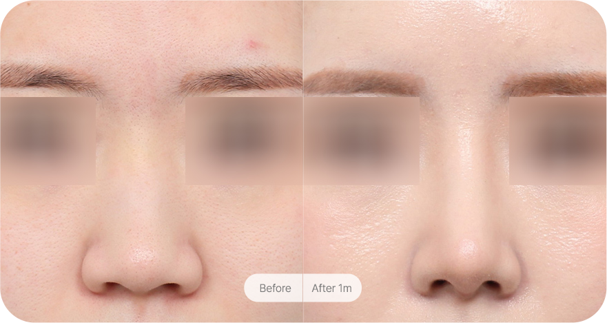 revision-rhinoplasty