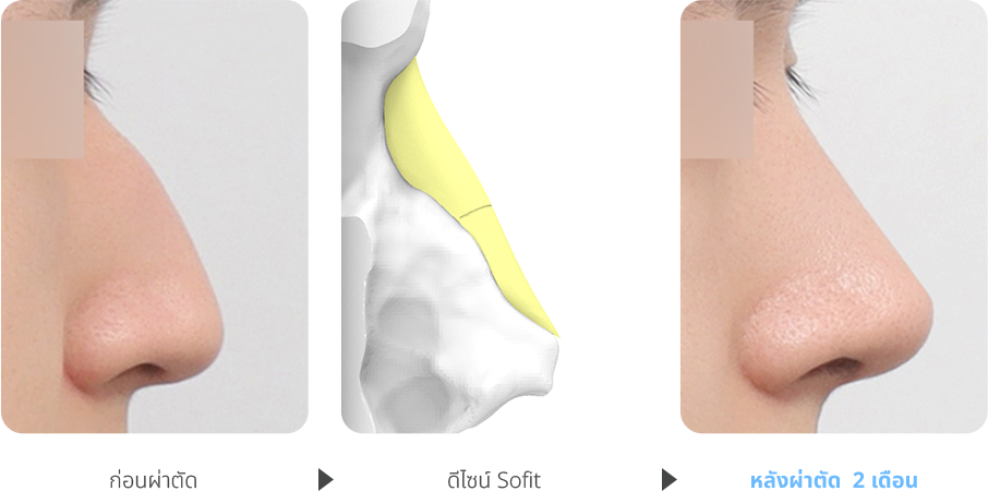 Severe Hump case