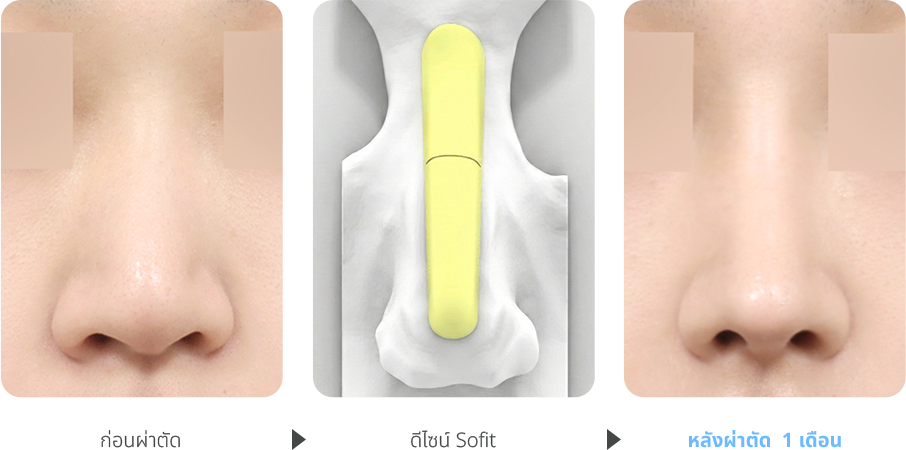 Deviated Nose case