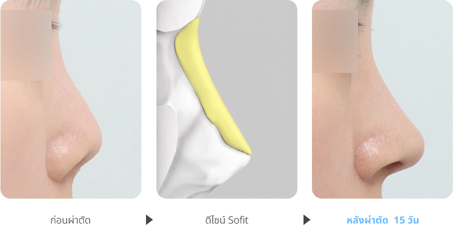 Contracted Nose case