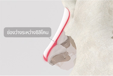 ศัลยกรรมจมูกทั่วไป