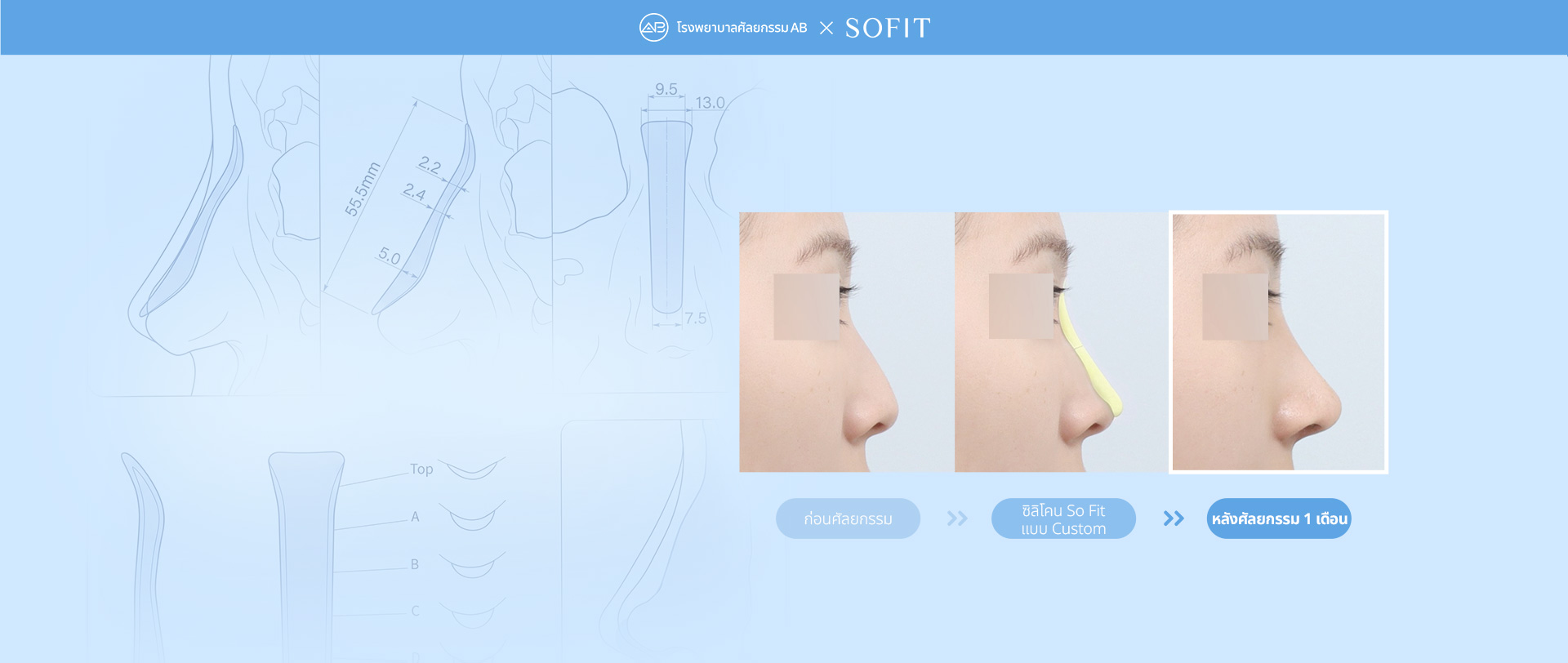 Sofit Nose