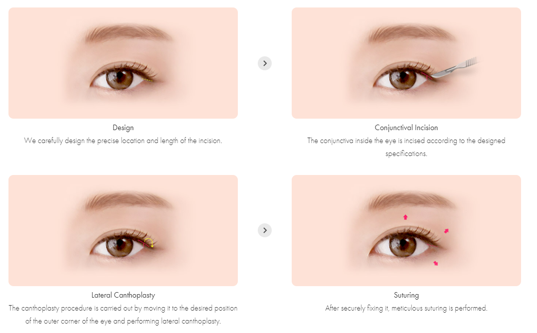 การผ่าตัดหางตาข้าง (Lateral Canthoplasty)