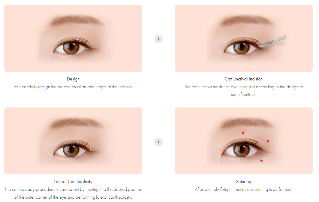 การผ่าตัดหางตา (Lateral Canthoplasty) ในประเทศเกาหลี