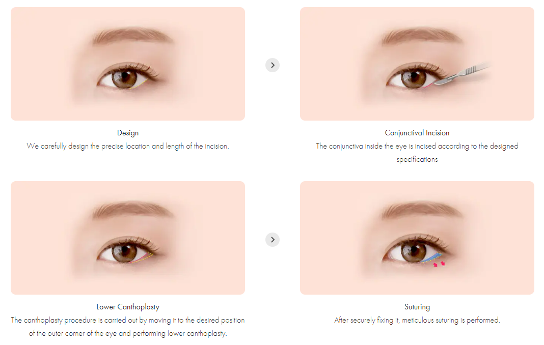 การผ่าตัดหางตาล่าง (Lower Canthoplasty) ในประเทศเกาหลี