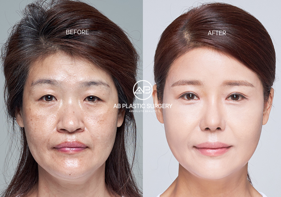 ก่อนและหลังร้อยไหม ที่ AB Plastic Surgery Korea