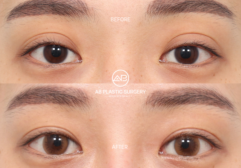 การทำ Blepharoplasty ในเกาหลี