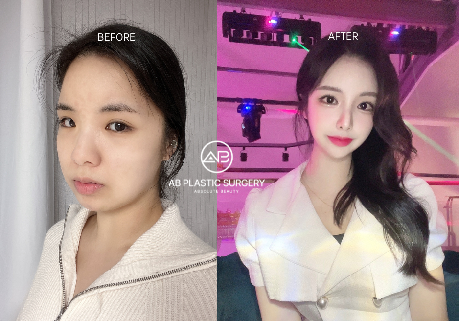 ศัลยกรรมหน้ากว้าง ที่ AB Plastic Surgery Korea