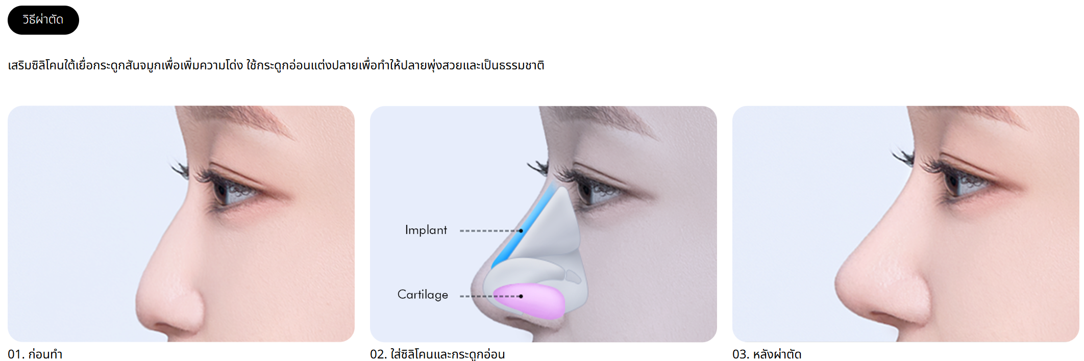 เสริมจมูกแบนเกาหลี