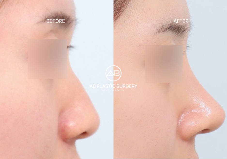 จมูกเกาหลี: การศัลยกรรมจมูกที่ AB Plastic Surgery