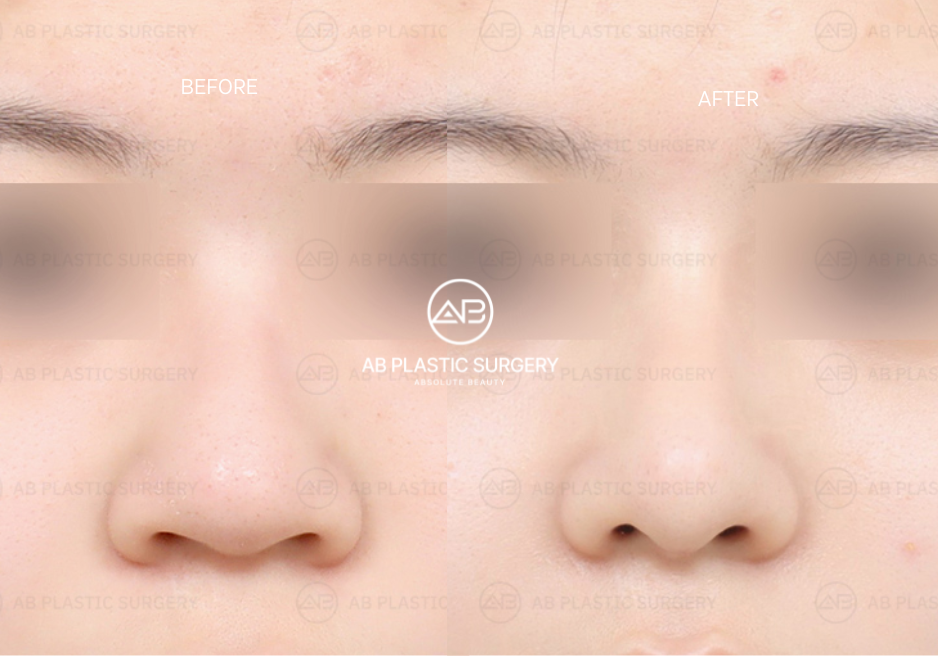 การลดขนาดรูจมูกที่ AB Plastic Surgery Korea