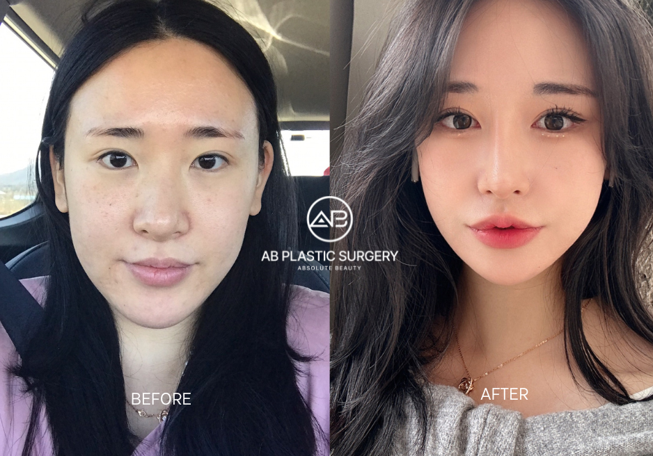 ศัลยกรรมวีไลน์แบบปลอดภัยที่ AB Plastic Surgery