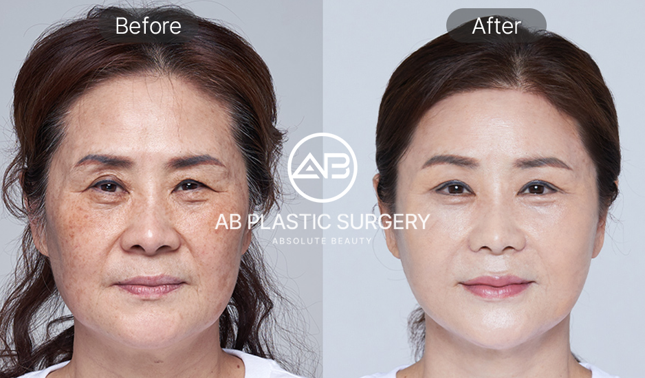 ภาพเปรียบเทียบก่อนและหลังยกกระชับใบหน้าที่เกาหลี