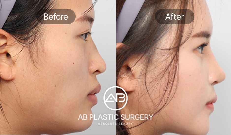 รูปภาพศัลยกรรมเสริมจมูกก่อนหลัง เกาหลีโรงพยาบาลศัลยกรรมAB