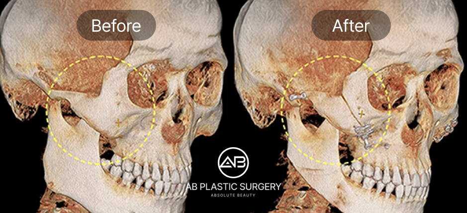 ภาพ Before & After การยึดกระดูกโหนกแก้มด้วย Titanium Pin แบบสองชั้น