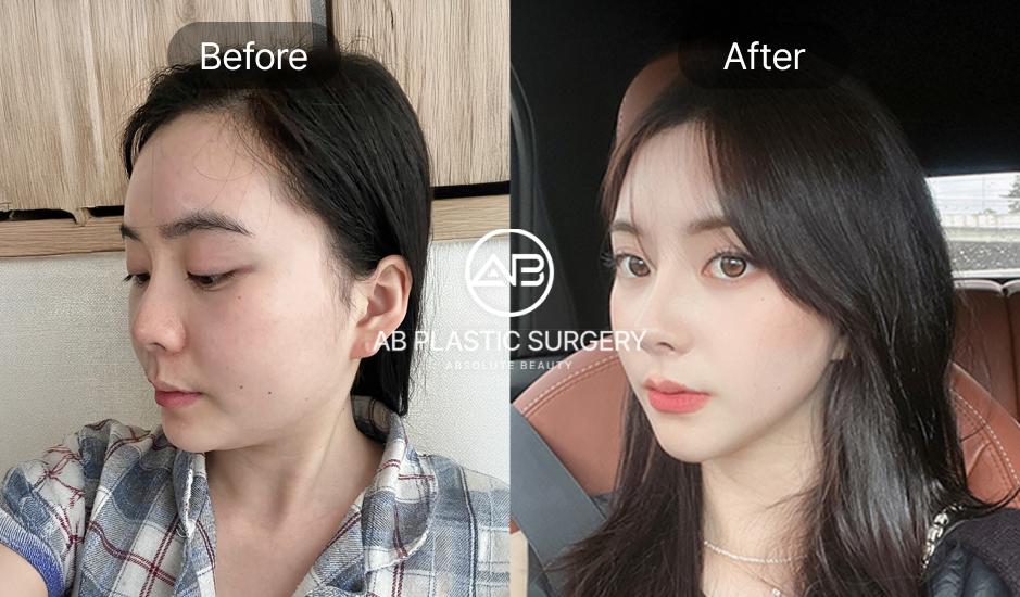 รีวิวลูกค้า หลังเสริมจมูกครบ 1 เดือน พร้อมภาพก่อน–หลัง