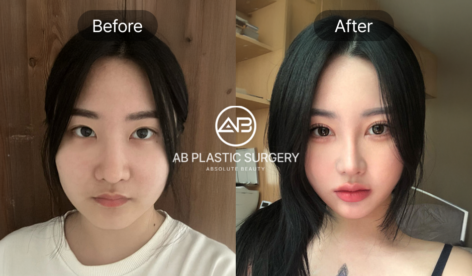 รีวิวลูกค้า เสริมจมูกครบ 2 เดือน พร้อมภาพก่อน–หลัง แผลผ่าตัดแทบไม่เห็นเลย!