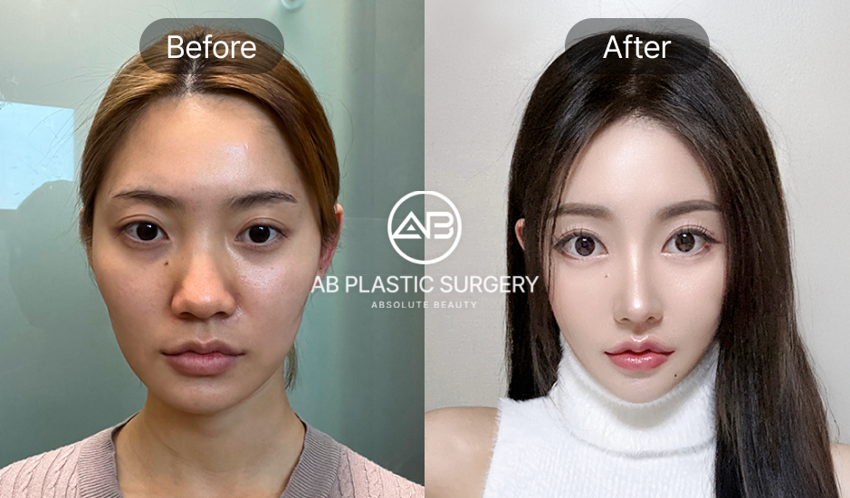 รีวิวลูกค้า เสริมจมูกครบ 3 เดือน เป็นธรรมชาติเหมือนจมูกจริงเลยค่ะ