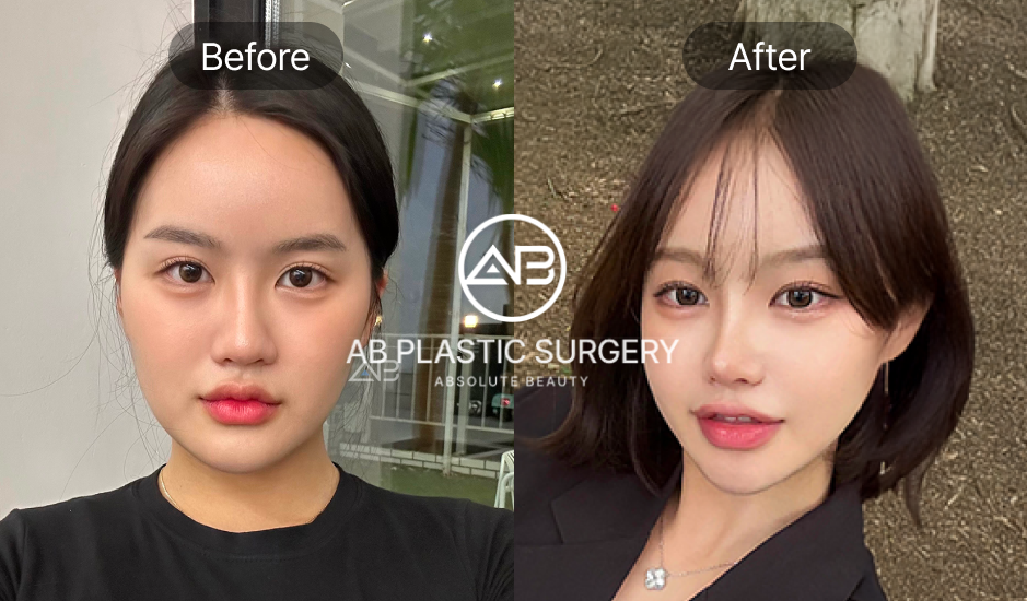 หลังเสริมจมูกครบ 5–6 เดือน ทรงยังสวยและหน้าดูละมุนขึ้นอย่างเป็นธรรมชาติ