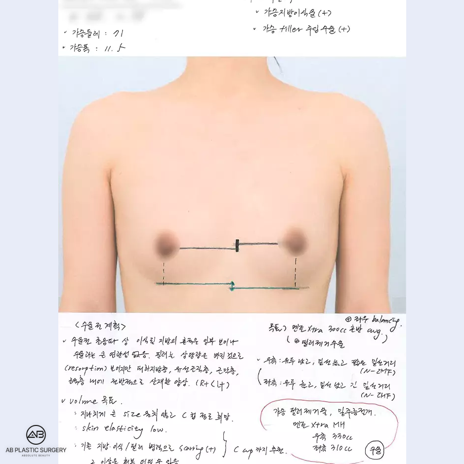 ภาพการออกแบบและวัดขนาดหน้าอกก่อนผ่าตัดศัลยกรรมที่โรงพยาบาลศัลยกรรม AB ประเทศเกาหลีภาพการออกแบบและวัดขนาดหน้าอกก่อนผ่าตัดศัลยกรรมที่โรงพยาบาลศัลยกรรม AB ประเทศเกาหลี