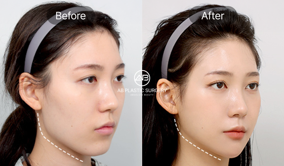 ภาพก่อน–หลังการตัดกราม ปรับโครงหน้าให้เรียวเล็กและสมส่วน รีวิวจริงจากโรงพยาบาลศัลยกรรม AB ประเทศเกาหลี
