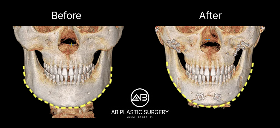 ภาพ CT สแกน ก่อน–หลัง การตัดกราม แสดงการปรับโครงกระดูกขากรรไกรให้แคบและสมส่วนมากขึ้น ด้วยเทคนิคศัลยกรรมโครงหน้าที่โรงพยาบาลศัลยกรรม AB ประเทศเกาหลี