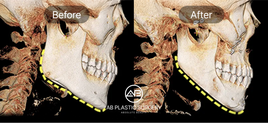 ภาพ CT สแกนก่อน–หลังการตัดกรามวีไลน์ แสดงการปรับกรามและคางให้เรียวยาวเป็น V Line ด้วยเทคนิคศัลยกรรมโครงหน้าที่โรงพยาบาลศัลยกรรม AB ประเทศเกาหลี
