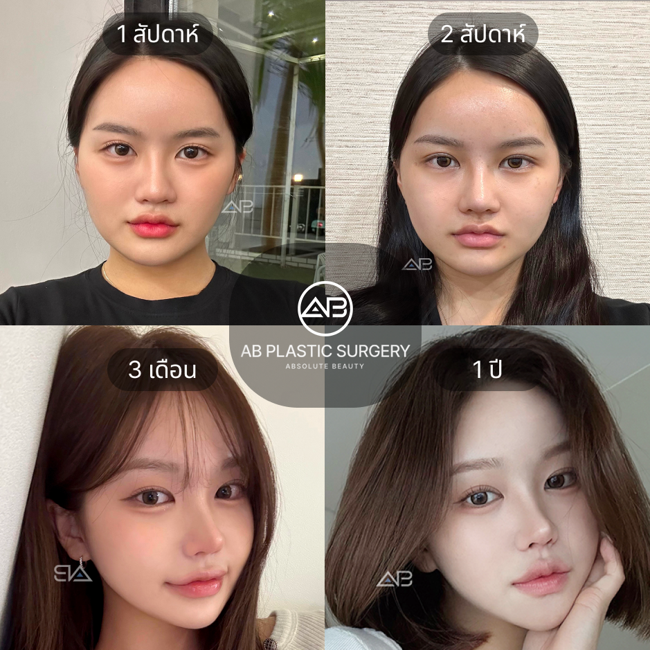 รีวิวก่อน–หลังตัดกราม ตั้งแต่ 1 สัปดาห์ ถึง 1 ปี แสดงการพักฟื้นและการเปลี่ยนแปลงโครงหน้าอย่างต่อเนื้อง ที่โรงพยาบาล AB ประเทศเกาหลี