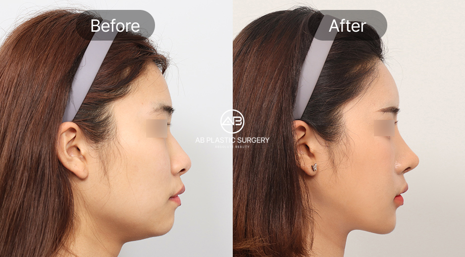 ศัลยกรรมคางถอยแบบเกาหลี ภาพเปรียบเทียบก่อนหลัง (Before After) ช่วยแก้ปัญหาคางสั้น กรอบหน้าไม่ชัด ให้รูปหน้าสมส่วน โดย โรงพยาบาลศัลยกรรมAB