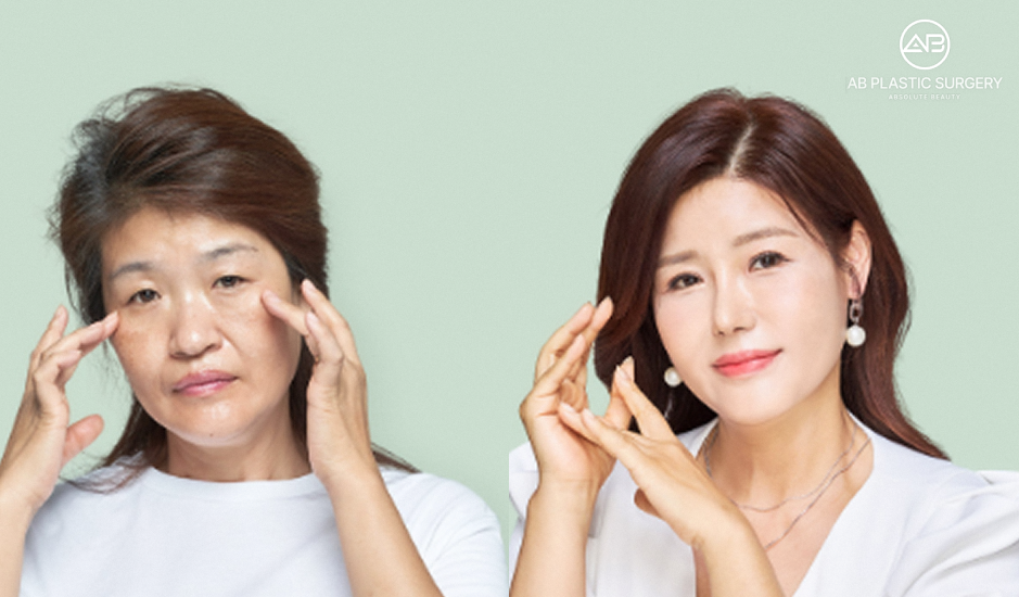ภาพก่อนและหลังการดึงหน้า เทคนิคดึงหน้าเกาหลี ลดความหย่อนคล้อย ยกกระชับผิวและกรอบหน้าให้ชัดเจนที่ โรงพยาบาลศัลยกรรมAB