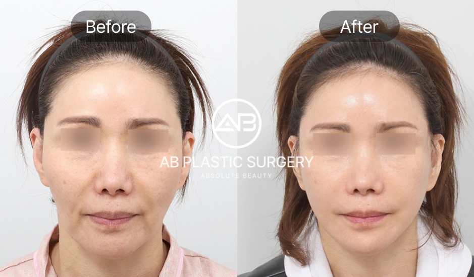 ภาพก่อนและหลังการดึงหน้าแบบมินิ (Mini Facelift) ที่ โรงพยาบาลศัลยกรรมAB แผลเล็ก ฟื้นตัวเร็ว เหมาะสำหรับผู้ที่มีผิวหย่อนคล้อยเล็กน้อย