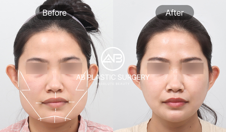 ภาพก่อนหลัง ศัลยกรรมลดโหนกแก้มสูงแบบเกาหลี ด้วยเทคโนโลยี 3D-CT ที่เกาหลีโรงพยาบาลศัลยกรรมAB แสดงการปรับโครงหน้าอย่างแม่นยำและปลอดภัย – ศัลยกรรมโหนกแก้ม, ปรับรูปหน้า, รูปก่อนหลังศัลยกรรม