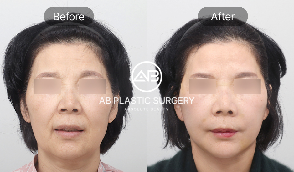 รีวิวภาพก่อนและหลังศัลยกรรมดึงหน้า แสดงตัวอย่างผู้ที่มีร่องแก้มลึกและผิวหย่อนคล้อย เห็นความแตกต่างชัดเจน เหมาะสำหรับผู้ที่ต้องการฟื้นฟูโครงหน้าและความอ่อนเยาว์