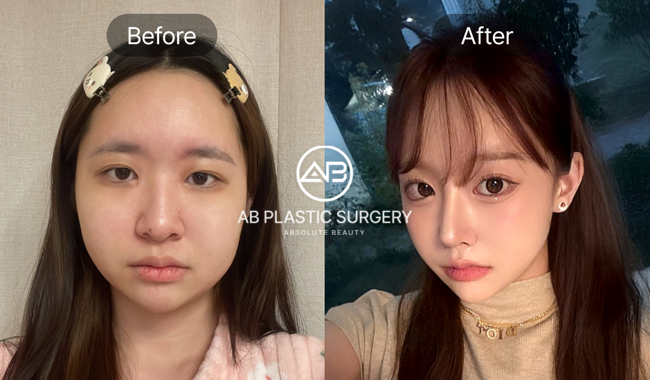 ภาพก่อนหลัง ศัลยกรรมลดโหนกแก้มสูงแบบเกาหลี ที่เกาหลีโรงพยาบาลศัลยกรรมAB แสดงข้อดีและข้อควรระวังของการผ่าตัด พร้อมผลลัพธ์ที่ช่วยปรับรูปหน้าให้ละมุนและมั่นใจมากขึ้น – ศัลยกรรมโหนกแก้ม, ปรับรูปหน้า, รูปก่อนหลังศัลยกรรม