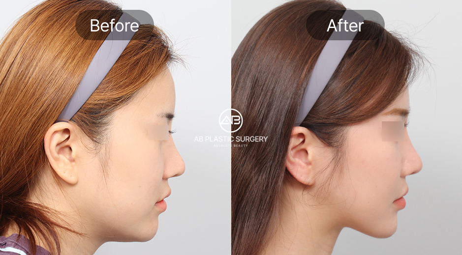 ศัลยกรรมคางถอยแบบเกาหลี ภาพก่อนหลัง (Before After) รีวิวประสบการณ์จริงจากผู้เข้ารับบริการ โรงพยาบาลศัลยกรรมAB