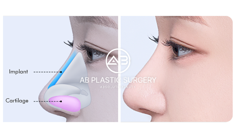 ภาพแสดงเทคนิคศัลยกรรมเสริมจมูกสไตล์เกาหลี ใช้ซิลิโคนและกระดูกอ่อนร่วมกัน พร้อมตัวอย่างผลลัพธ์ด้านข้าง ศัลยกรรมจมูก โรงพยาบาลศัลยกรรมAB