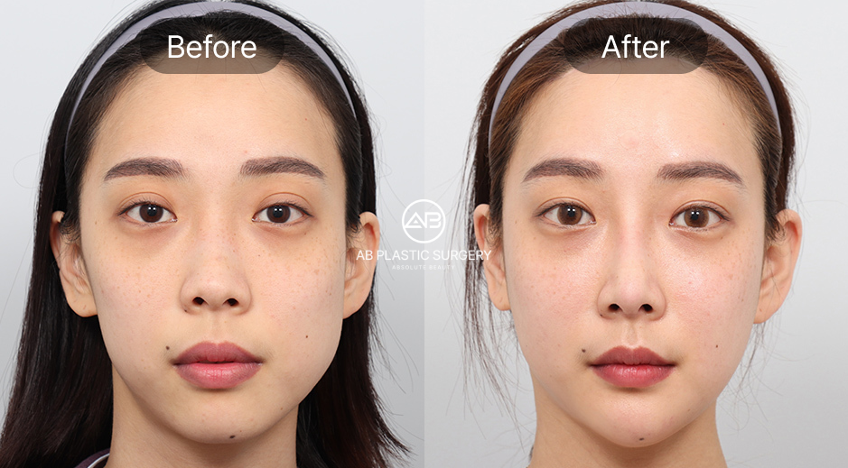 ภาพก่อนและหลังเสริมคางของผู้ที่มีคางไม่เท่ากัน ปรับแนวคางให้ตรงและสมดุลกับใบหน้าทั้งสองข้าง กรอบหน้าดูเรียวและละมุนขึ้นอย่างเป็นธรรมชาติ