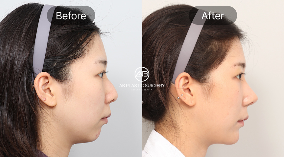 ภาพก่อนและหลังเสริมคางเกาหลีที่โรงพยาบาลศัลยกรรม AB ประเทศเกาหลี เคสคางถอย ปรับแนวคางให้ยื่นออกมาอย่างสมดุล ใบหน้าดูมีมิติและได้สัดส่วนตามแบบธรรมชาติ