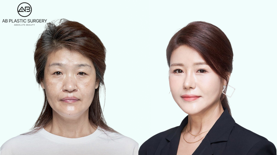 ก่อนและหลังร้อยไหมยกกระชับใบหน้าแบบเกาหลี ผลลัพธ์หลังทำทันทีและการยกกระชับที่เห็นได้ชัด