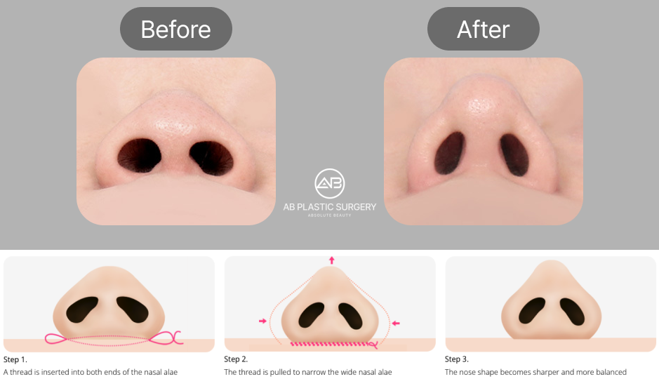 ภาพแสดงเทคนิคการตัดปีกจมูกแบบเย็บด้านในและผลลัพธ์ก่อน–หลังการผ่าตัด เหมาะสำหรับผู้ที่มีฐานรูจมูกกว้างเล็กน้อย ช่วยให้รูจมูกดูแคบลงโดยไม่มีรอยแผลด้านนอก