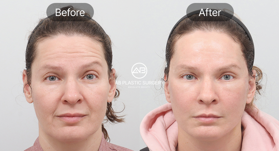 ก่อนและหลังยกกระชับใบหน้า เปรียบเทียบผลลัพธ์ร้อยไหม เกาหลี กับ HIFU และ Ulthera