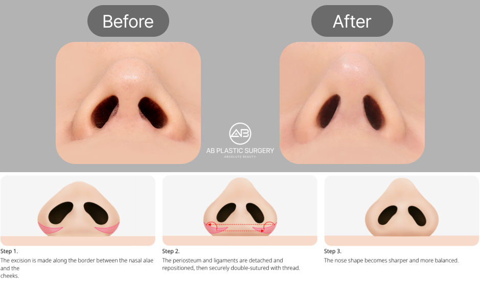 ภาพก่อน–หลังศัลยกรรมตัดปีกจมูกแบบตัดเย็บจากด้านนอก แสดงผลลัพธ์รูจมูกที่แคบลงและได้สัดส่วนกับใบหน้า