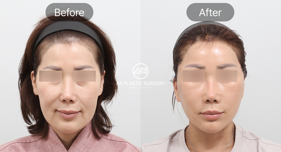 ก่อนและหลังร้อยไหมยกกระชับใบหน้าแบบเกาหลี ปรับกรอบหน้าให้เรียวชัดและลดความหย่อนคล้อย